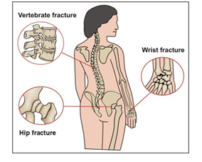 Osteoporóza – řídnutí kosti